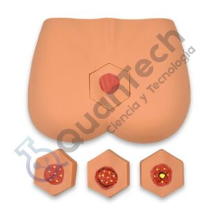 MODELO DE ATENCION DE ULCERAS POR DECUBITO EN 4 ETAPAS