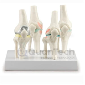 MODELO DE RODILLA CON PATOLOGÍAS EN 4 ESTAPAS